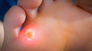9 effective ways to get rid of calluses at home